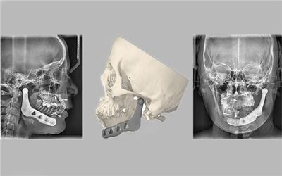 پروتز فک پایین با روش پرینت سه‌بعدی ساخته شد