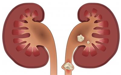 افزایش سالانه 100 هزارنفری بیماران مبتلا به کلیه سنگ ساز